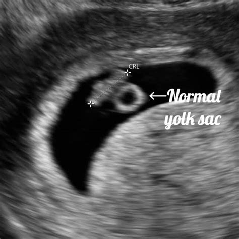 6 week ultrasound dating accuracy